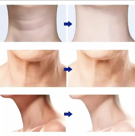 Masajeador Facial con Fototerapia Antiarrugas/ Efecto Lifting PRO